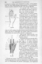 Fig. 246., Fig. 247 - Traité de médecine opératoire, bandages et appareils. 4è éd. Tome second