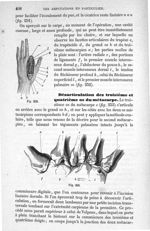 Fig. 252., Fig. 253 - Traité de médecine opératoire, bandages et appareils. 4è éd. Tome second
