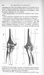 Fig. 256., Fig. 257 - Traité de médecine opératoire, bandages et appareils. 4è éd. Tome second