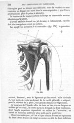 Fig. 258 - Traité de médecine opératoire, bandages et appareils. 4è éd. Tome second
