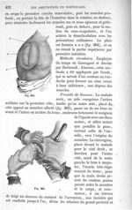 Fig. 264., Fig. 265 - Traité de médecine opératoire, bandages et appareils. 4è éd. Tome second