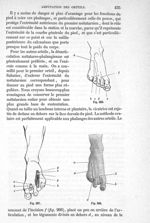 Fig. 266 à Fig. 268 - Traité de médecine opératoire, bandages et appareils. 4è éd. Tome second