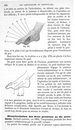 Fig. 275., Fig. 276 - Traité de médecine opératoire, bandages et appareils. 4è éd. Tome second