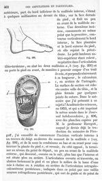 Fig. 290., Fig. 291 - Traité de médecine opératoire, bandages et appareils. 4è éd. Tome second