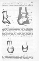 Fig. 292. à Fig. 295 - Traité de médecine opératoire, bandages et appareils. 4è éd. Tome second