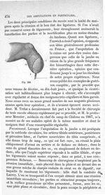 Fig. 300 - Traité de médecine opératoire, bandages et appareils. 4è éd. Tome second