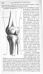 Fig. 302 - Traité de médecine opératoire, bandages et appareils. 4è éd. Tome second