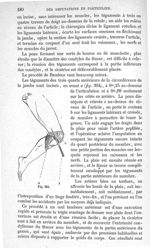 Fig. 304 - Traité de médecine opératoire, bandages et appareils. 4è éd. Tome second