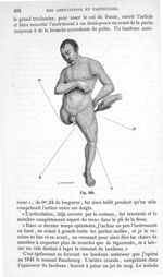 Fig. 309 - Traité de médecine opératoire, bandages et appareils. 4è éd. Tome second