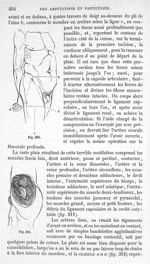 Fig. 310., Fig. 311 - Traité de médecine opératoire, bandages et appareils. 4è éd. Tome second