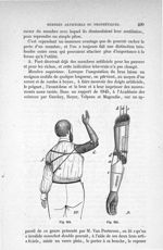 Fig. 314., Fig. 315 - Traité de médecine opératoire, bandages et appareils. 4è éd. Tome second