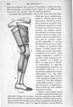 Fig. 324 - Traité de médecine opératoire, bandages et appareils. 4è éd. Tome second