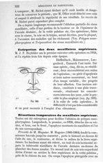 Fig. 335 - Traité de médecine opératoire, bandages et appareils. 4è éd. Tome second
