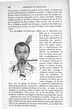 Fig. 339 - Traité de médecine opératoire, bandages et appareils. 4è éd. Tome second