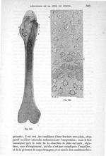Fig. 345., Fig. 346 - Traité de médecine opératoire, bandages et appareils. 4è éd. Tome second