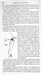 Fig. 347 - Traité de médecine opératoire, bandages et appareils. 4è éd. Tome second
