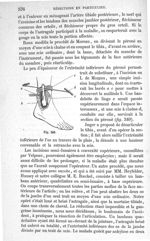 Fig. 349 - Traité de médecine opératoire, bandages et appareils. 4è éd. Tome second