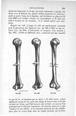 Fig. 352 à Fig. 354 - Traité de médecine opératoire, bandages et appareils. 4è éd. Tome second