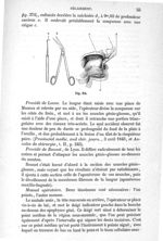 Fig. 374 - Traité de médecine opératoire, bandages et appareils. 4è éd. Tome premier