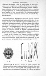 Fig. 384., Fig. 385 - Traité de médecine opératoire, bandages et appareils. 4è éd. Tome premier