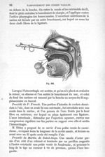 Fig. 392 - Traité de médecine opératoire, bandages et appareils. 4è éd. Tome premier