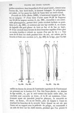 Fig. 395. à Fig. 398 - Traité de médecine opératoire, bandages et appareils. 4è éd. Tome premier