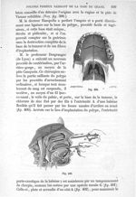 Fig. 399., Fig. 400 - Traité de médecine opératoire, bandages et appareils. 4è éd. Tome premier