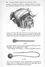 Fig. 401 à Fig. 403 - Traité de médecine opératoire, bandages et appareils. 4è éd. Tome premier