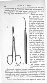 Fig. 431 bis - Traité de médecine opératoire, bandages et appareils. 4è éd. Tome premier