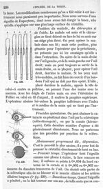 Fig. 438., Fig. 439 - Traité de médecine opératoire, bandages et appareils. 4è éd. Tome premier