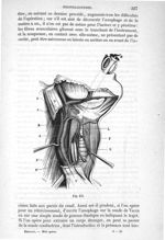 Fig. 471 - Traité de médecine opératoire, bandages et appareils. 4è éd. Tome premier