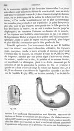 Fig. 472., Fig. 473 - Traité de médecine opératoire, bandages et appareils. 4è éd. Tome premier