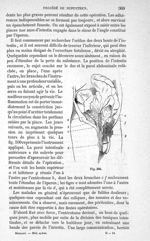 Fig. 500 - Traité de médecine opératoire, bandages et appareils. 4è éd. Tome premier