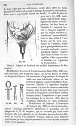 Fig. 501 à Fig. 504 - Traité de médecine opératoire, bandages et appareils. 4è éd. Tome premier