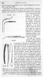 Fig. 506 à Fig. 511 - Traité de médecine opératoire, bandages et appareils. 4è éd. Tome premier