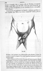 Fig. 533 - Traité de médecine opératoire, bandages et appareils. 4è éd. Tome premier