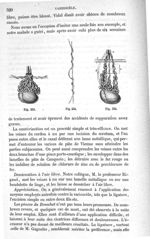 Fig. 553 à Fig. 555 - Traité de médecine opératoire, bandages et appareils. 4è éd. Tome premier