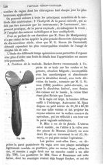 Fig. 559 - Traité de médecine opératoire, bandages et appareils. 4è éd. Tome premier