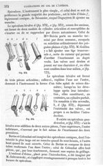 Fig. 572., Fig. 573 - Traité de médecine opératoire, bandages et appareils. 4è éd. Tome premier