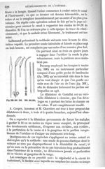 Fig. 590 à Fig. 595 - Traité de médecine opératoire, bandages et appareils. 4è éd. Tome premier