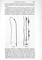 Fig. 641., Fig. 642 - Traité de médecine opératoire, bandages et appareils. 4è éd. Tome premier