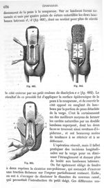 Fig. 661 à Fig. 663 - Traité de médecine opératoire, bandages et appareils. 4è éd. Tome premier