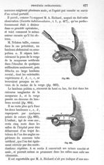Fig. 664., Fig. 665 - Traité de médecine opératoire, bandages et appareils. 4è éd. Tome premier