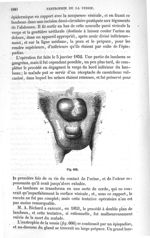 Fig. 666 - Traité de médecine opératoire, bandages et appareils. 4è éd. Tome premier