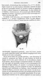 Fig. 667 - Traité de médecine opératoire, bandages et appareils. 4è éd. Tome premier