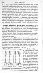 Fig. 675 à Fig. 678 - Traité de médecine opératoire, bandages et appareils. 4è éd. Tome premier
