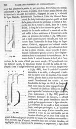 Fig. 689., Fig. 690 - Traité de médecine opératoire, bandages et appareils. 4è éd. Tome premier