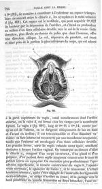 Fig. 691 - Traité de médecine opératoire, bandages et appareils. 4è éd. Tome premier