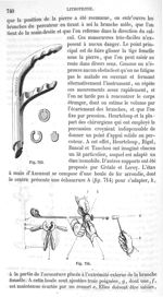 Fig. 713., Fig. 714 - Traité de médecine opératoire, bandages et appareils. 4è éd. Tome premier