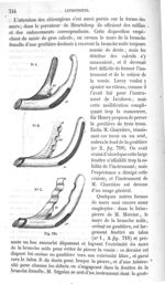 Fig. 718 - Traité de médecine opératoire, bandages et appareils. 4è éd. Tome premier